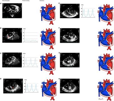 Transesophageal echocardiography-guided percutaneous closure of multiple muscular ventricular septal defects with pulmonary hypertension using single device: A case report